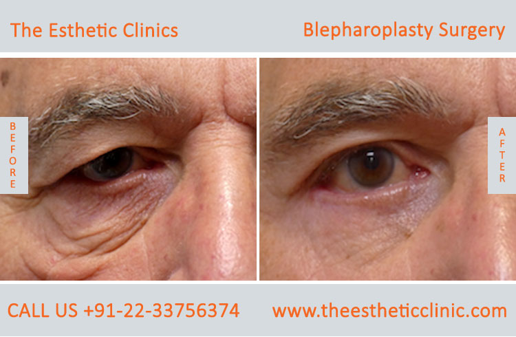 Blepharoplasty Surgery, Eyelid lift surgery before after photos in mumbai india (3)